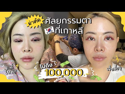 ผ่าตัดศัลยกรรมตาที่เกาหลี EP.2 ไม่ถึง100,000บาท Beauty Surgery | Jane Soraya