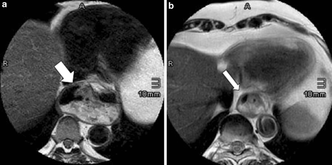 Swallowing Mri For Gerd—Diagnosis And Treatment Monitoring | European  Surgery