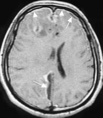 Bacterial Meningitis Imaging: Practice Essentials, Computed Tomography,  Magnetic Resonance Imaging