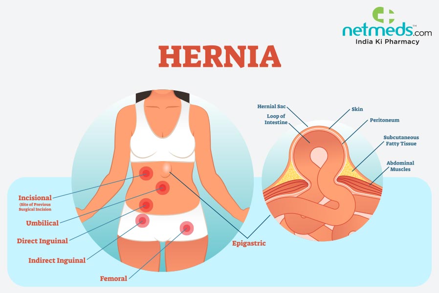Hernia: Causes, Symptoms And Treatment