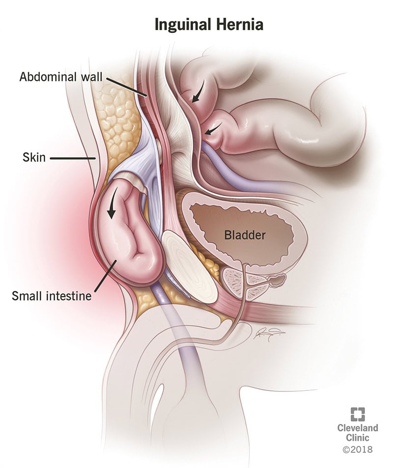 Inguinal Hernia: Types, Causes, Symptoms & Treatment