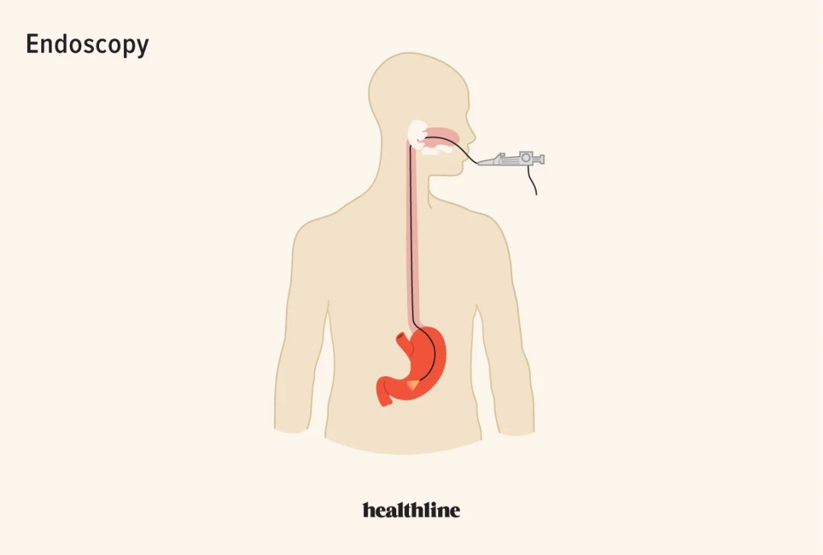 Gerd Endoscopy: Purpose, Preparation, Procedure, Aftercare