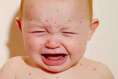 4 Rules To Remember When Taking Care Of A Child With Measles | Vinmec