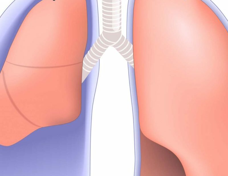 Punctured Lung (Pneumothorax): Symptoms, Treatment, And Recovery