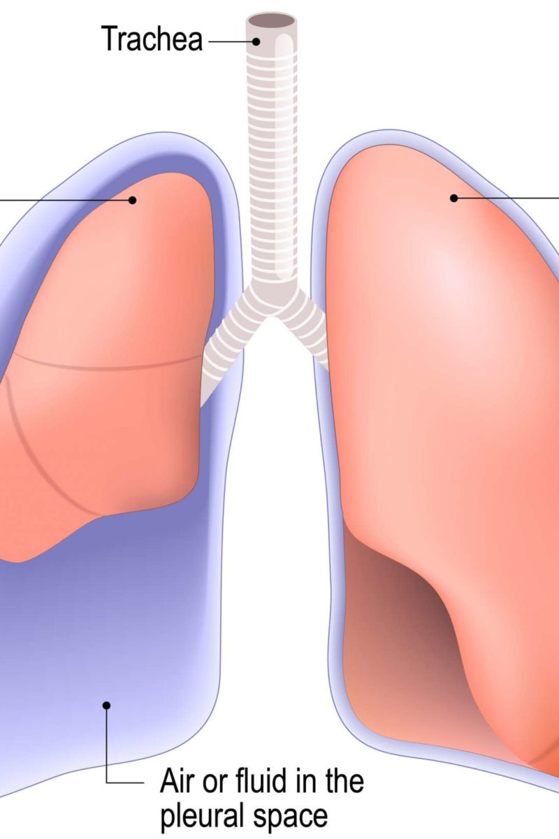 Punctured Lung (Pneumothorax): Symptoms, Treatment, And Recovery