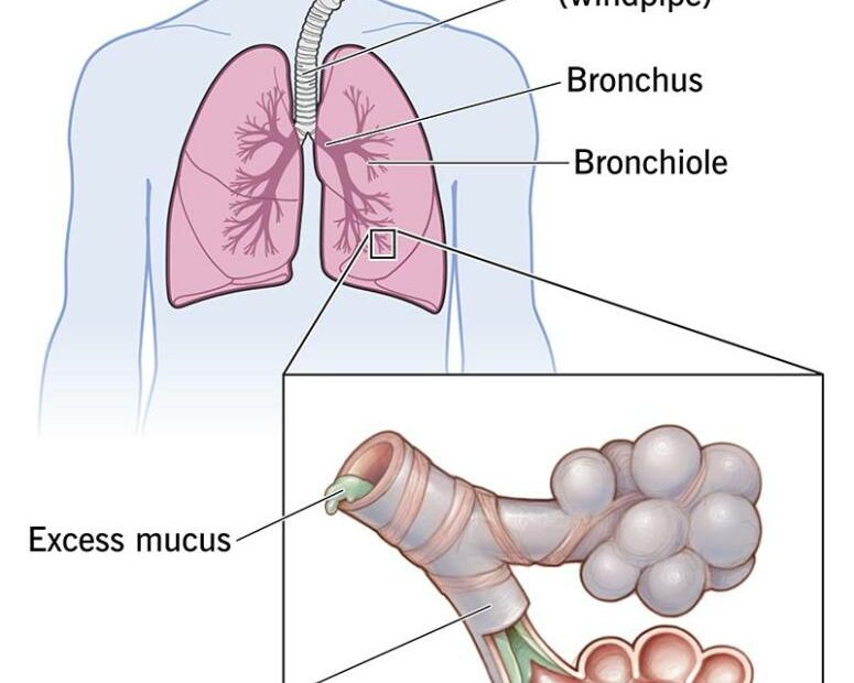 Bronchitis: Causes, Symptoms, Diagnosis & Treatment