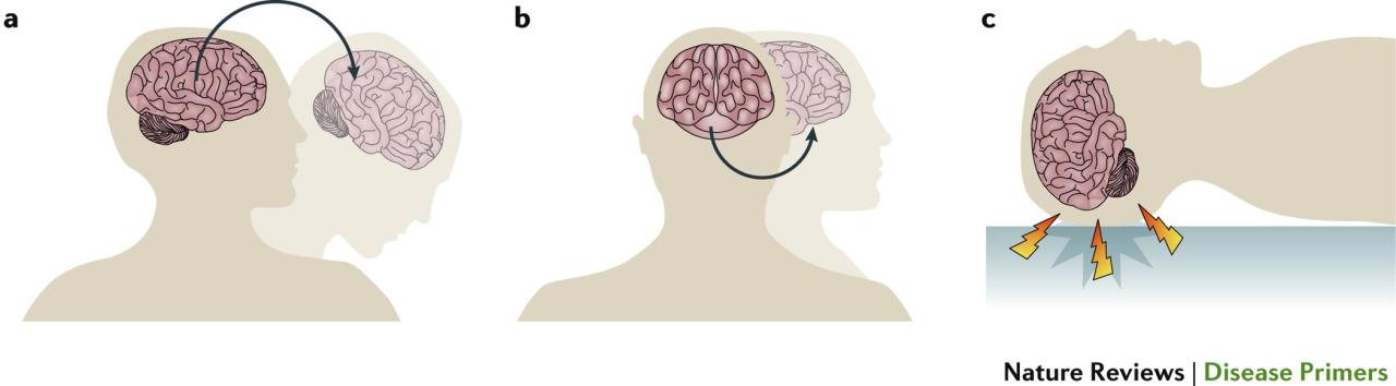 Traumatic Brain Injuries | Nature Reviews Disease Primers