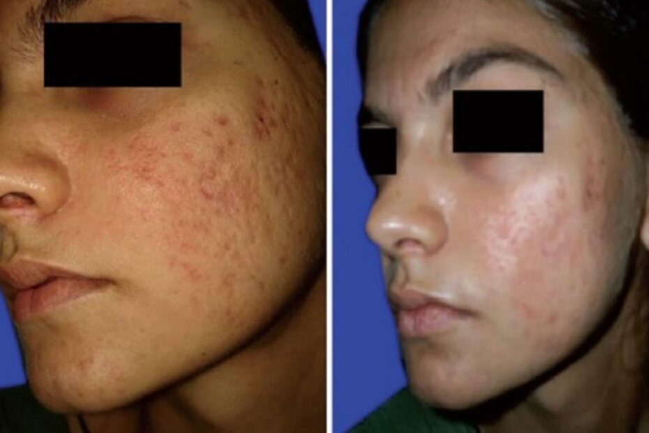 Chemical Peels Before And After Results: Photos And Healing Time