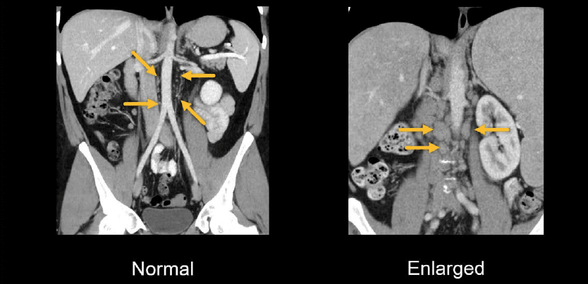 Abdominal Ct: Lymph Nodes • Litfl • Radiology Library