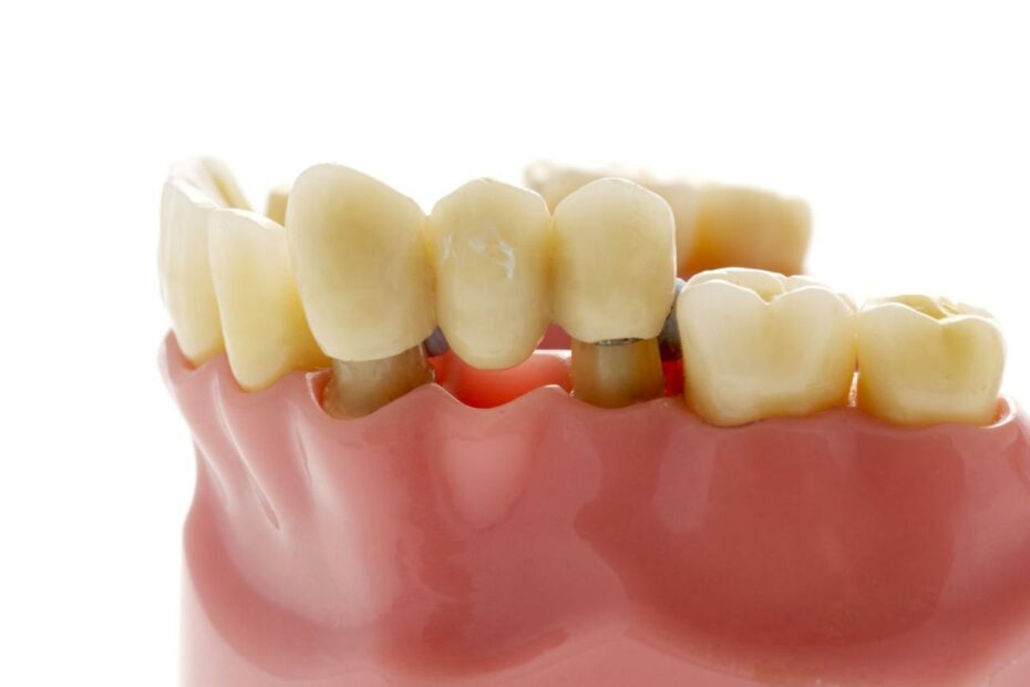 Dental Bridge: Types, Advantages, Cost, And More