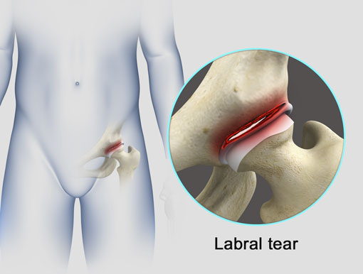 Labral Tears Of The Hip — Champion Performance & Physical Therapy