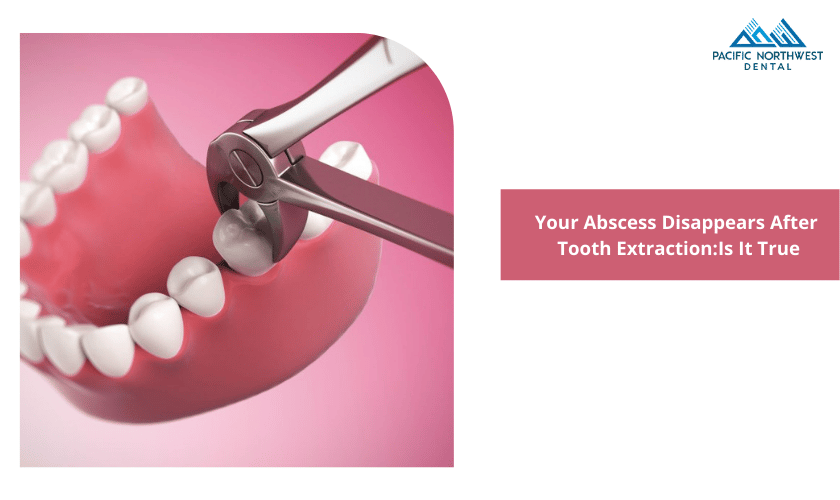 What Happens To Your Abscess After Tooth Extraction