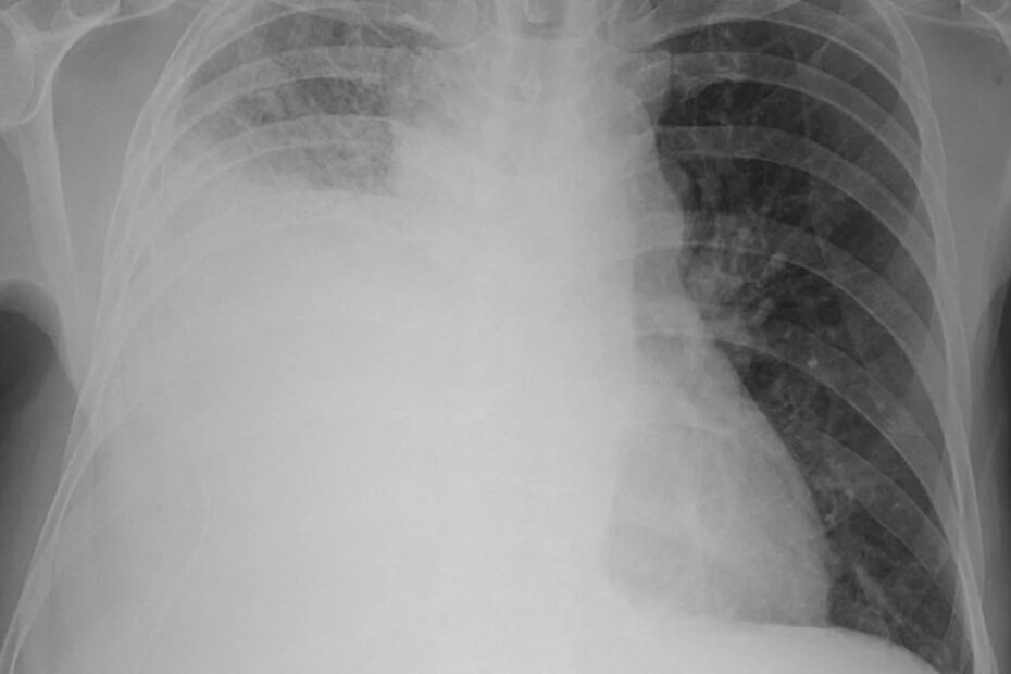 Heart Failure: How Does It Appear On A Chest X-Ray?