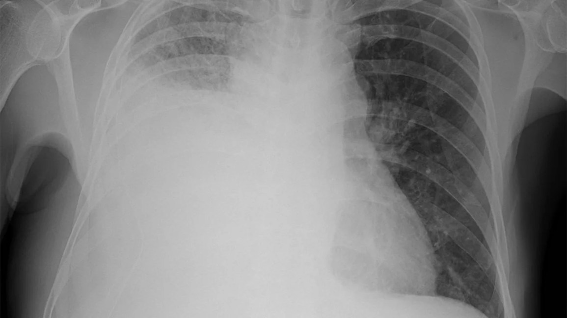 Heart Failure: How Does It Appear On A Chest X-Ray?