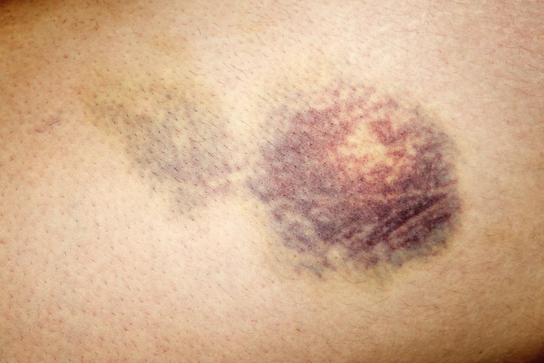 Hematoma: Overview, Types, Treatment, And Pictures