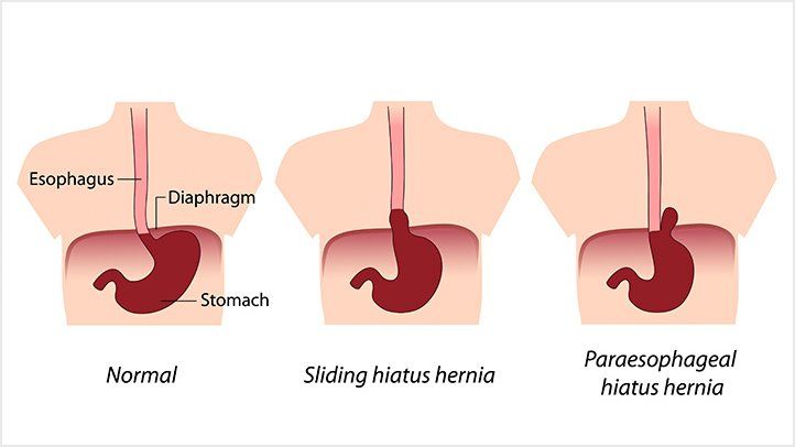 What Is A Hiatal Hernia? Symptoms, Causes, Diagnosis, Treatment, And  Prevention