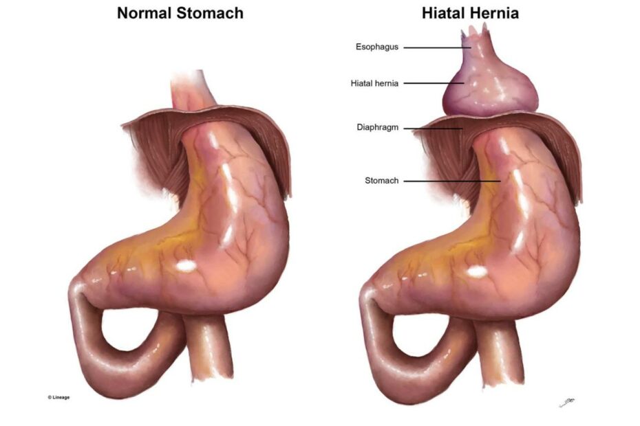 Hiatal Hernia - Gastrointestinal - Medbullets Step 2/3