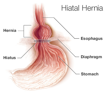 Hiatal Hernias — Suncoast Surgical Associates