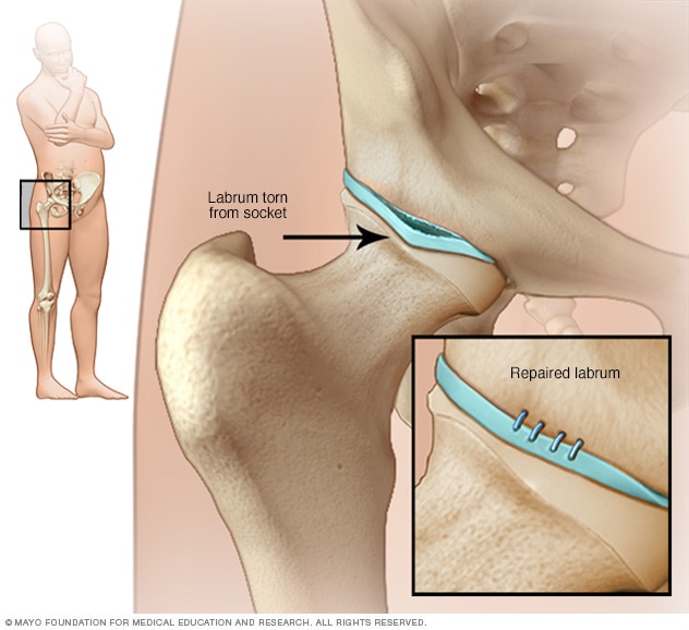 Hip Labral Tear - Symptoms & Causes - Mayo Clinic