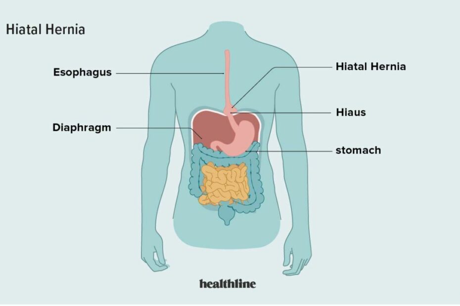 Hiatal Hernia: Symptoms, Surgery, Treatment, And More