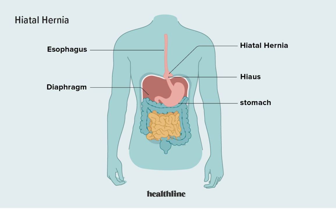 Hiatal Hernia: Symptoms, Surgery, Treatment, And More