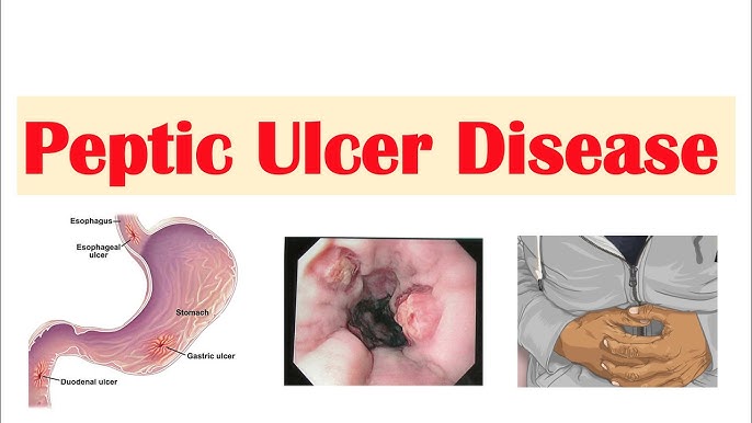 Peptic Ulcer Disease Signs & Symptoms | Gastric Vs. Duodenal Ulcers -  Youtube