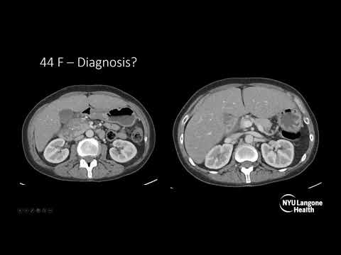 Imaging findings in Pancreatitis