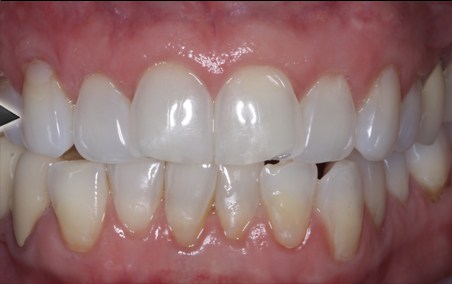 Can Receding Gums Be Reversed?