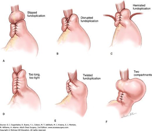 Management Of The Failed Reflux Operation | Thoracic Key