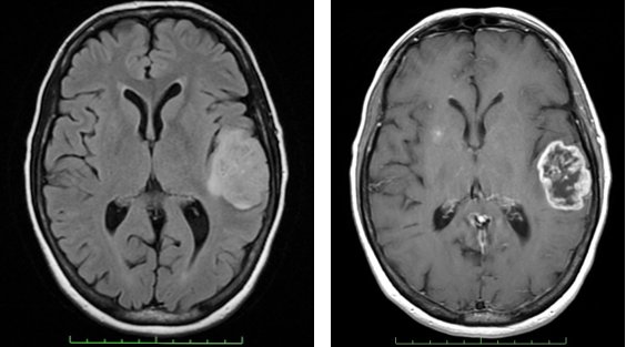 Can An Mri Miss A Brain Tumor Without Contrast? - Quora