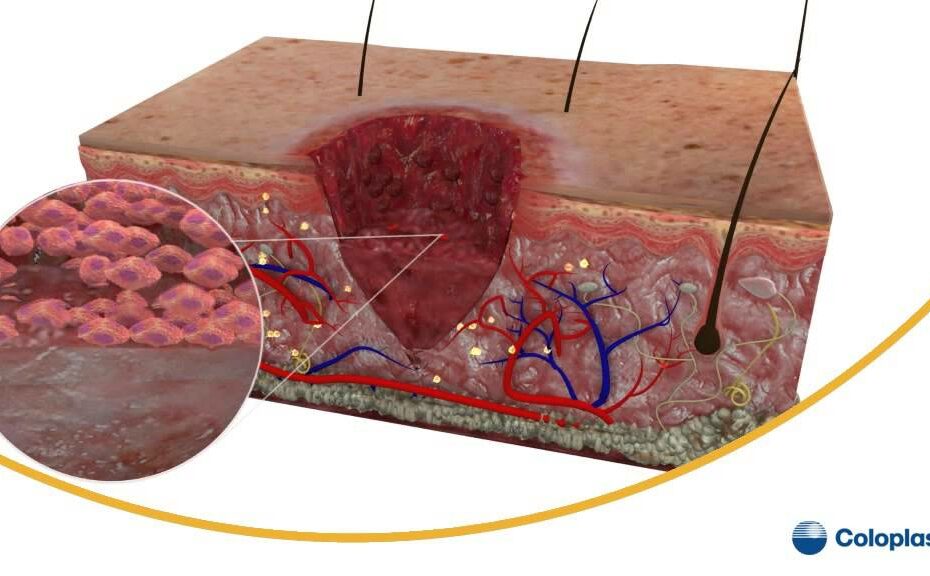 Understanding The Wound Healing Process