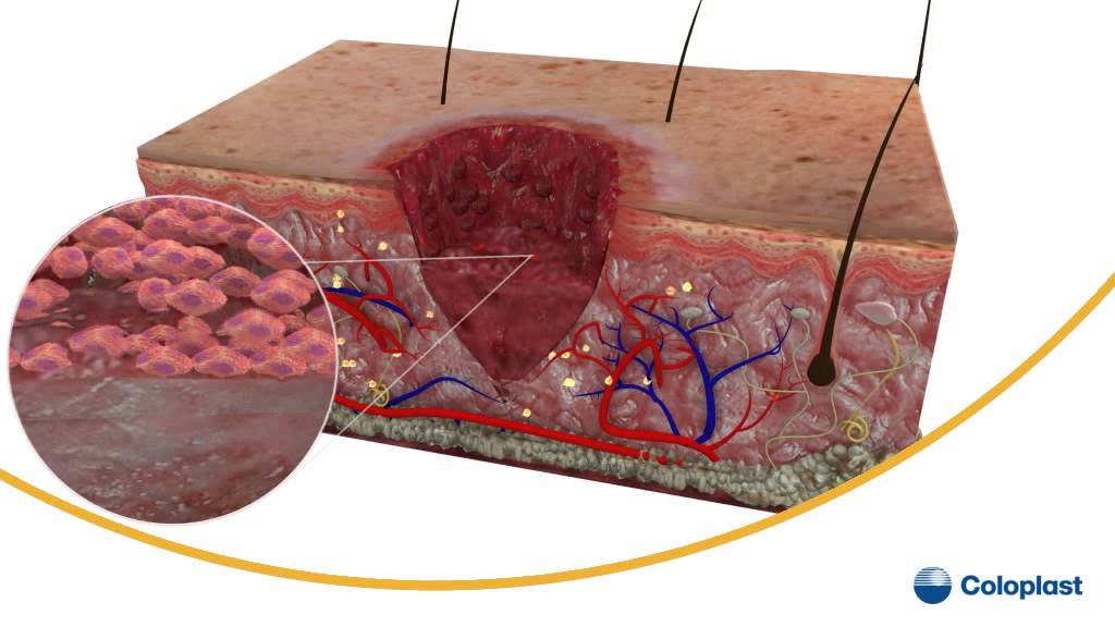 Understanding The Wound Healing Process