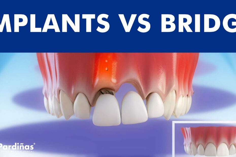 Dental Implants Vs Tooth Bridge - Comparison © - Youtube