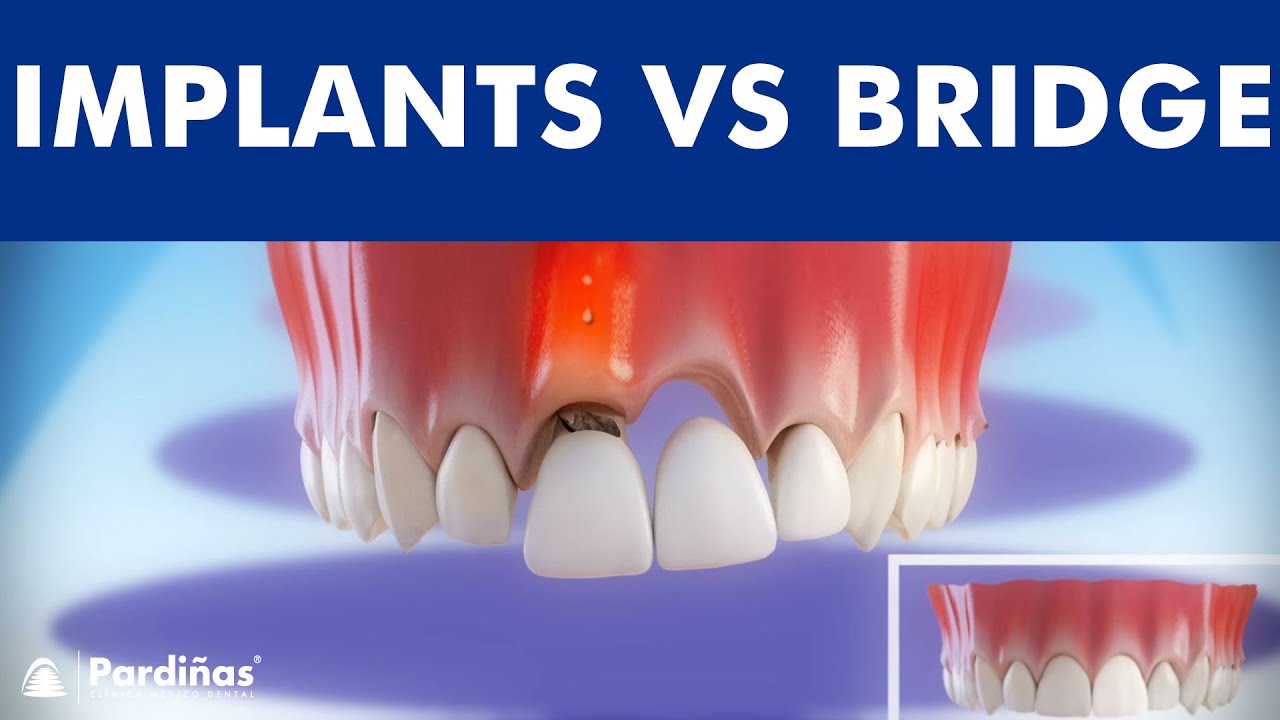 Dental Implants Vs Tooth Bridge - Comparison © - Youtube