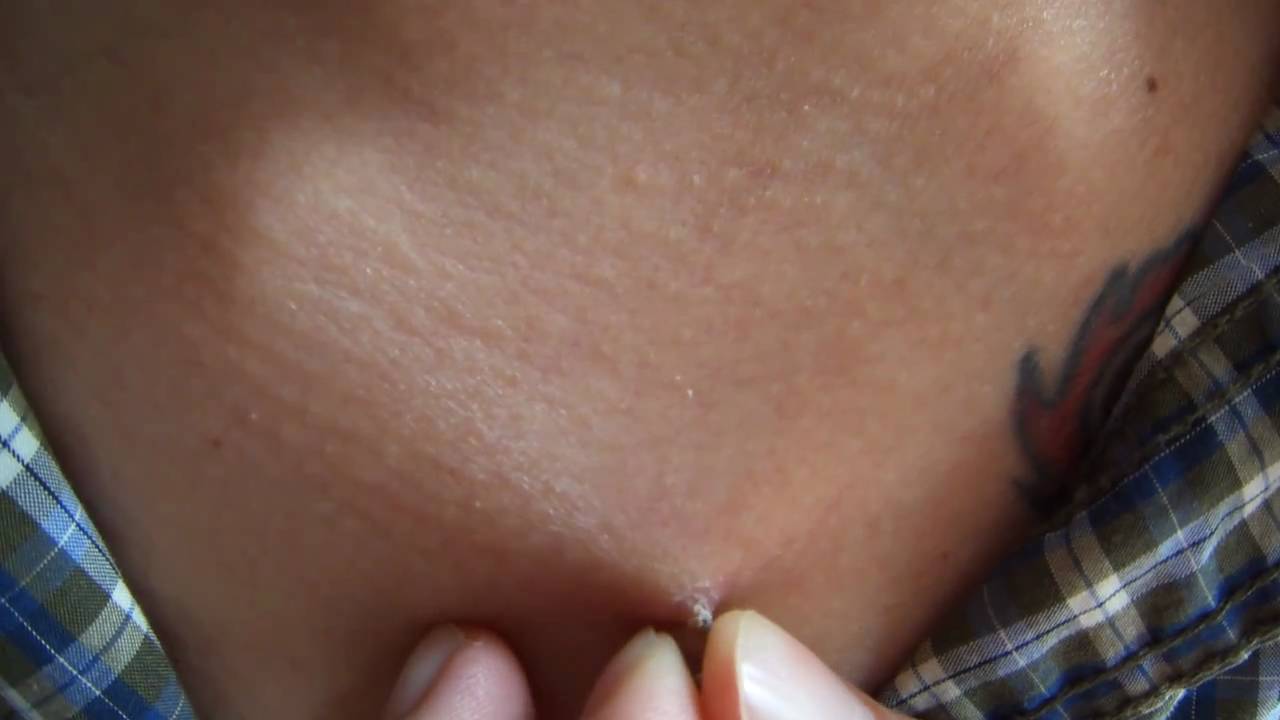 Pulling My Dermal Anchor Piercing Out Myself – Sixthseal.Com