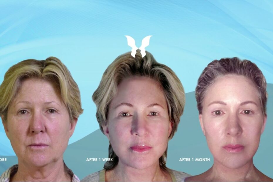 Wave Facelift Patient - Looks And Feels 20 Years Younger! - Youtube