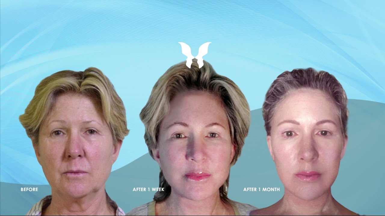 Wave Facelift Patient - Looks And Feels 20 Years Younger! - Youtube