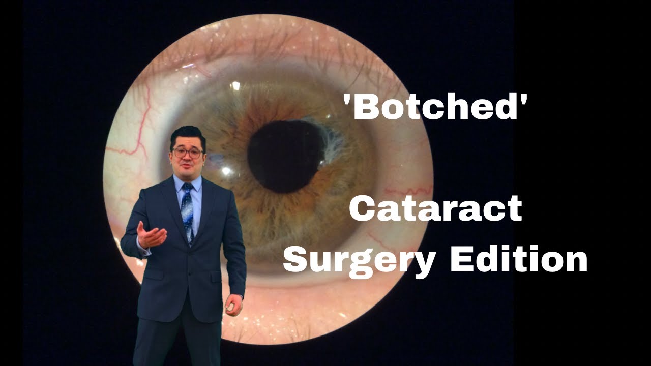 What Is A Botched Cataract Surgery? | Desert Vision Center