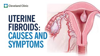 Uterine Fibroids: Causes, Symptoms & Treatment