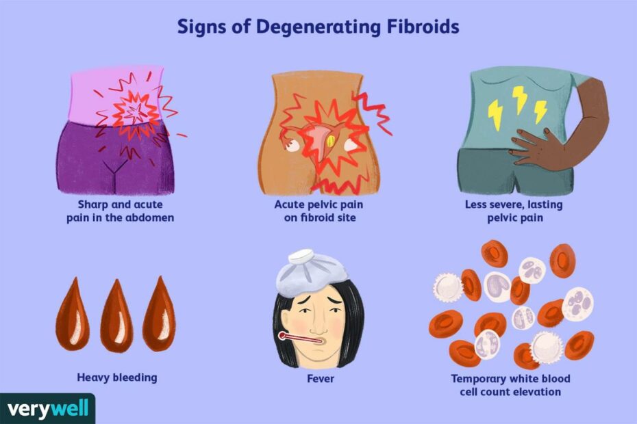 Signs Of Fibroids Breaking Down And Treatment
