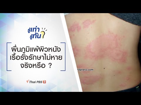 ผื่นภูมิแพ้ผิวหนัง เรื้อรังรักษาไม่หายจริงหรือ ? : รู้เท่ารู้ทัน (15 ก.ค. 63)