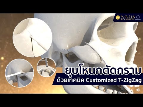 ยุบโหนกแก้ม ตัดกราม แบบ T- customized Technique เทคนิคเฉพาะของ โรงพยาบาลเอเชีย