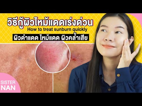 ฟื้นฟูผิวไหม้แดด รักษาผิวดำแดด กำจัดผิวหมองคล้ำ แบบเร่งด่วน Treat Sunburn Quickly! | แนน Sister Nan